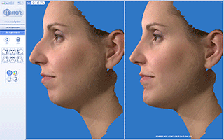 Burun ve yüz estetiğinde 3D görüntüleme | 4