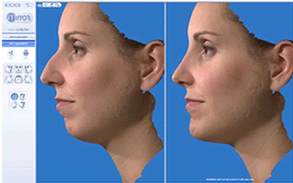 Revizyon (Düzeltici) Burun Estetik Ameliyatı Revizyon (Düzeltici) Burun Estetik Ameliyatı