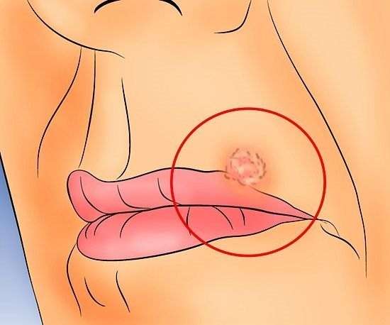 aids_belirtileri (8)