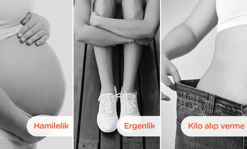 bio-oil-catlak-kremi.webp