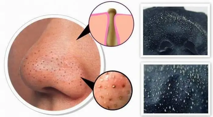 burun_ustundeki_siyah_noktalara_maske_tarifi_peeling.webp