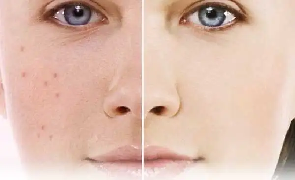 cilt_lekelerinden_siyah_noktalardan_kurtaran_maske_tarifleri.webp