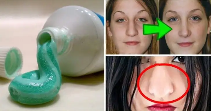 Dis_macunu_burun_kucultme_ameliyatsiz_estetik.webp