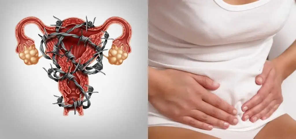 Endometriozis_ne_demek_agrili_adet_agrilari.webp