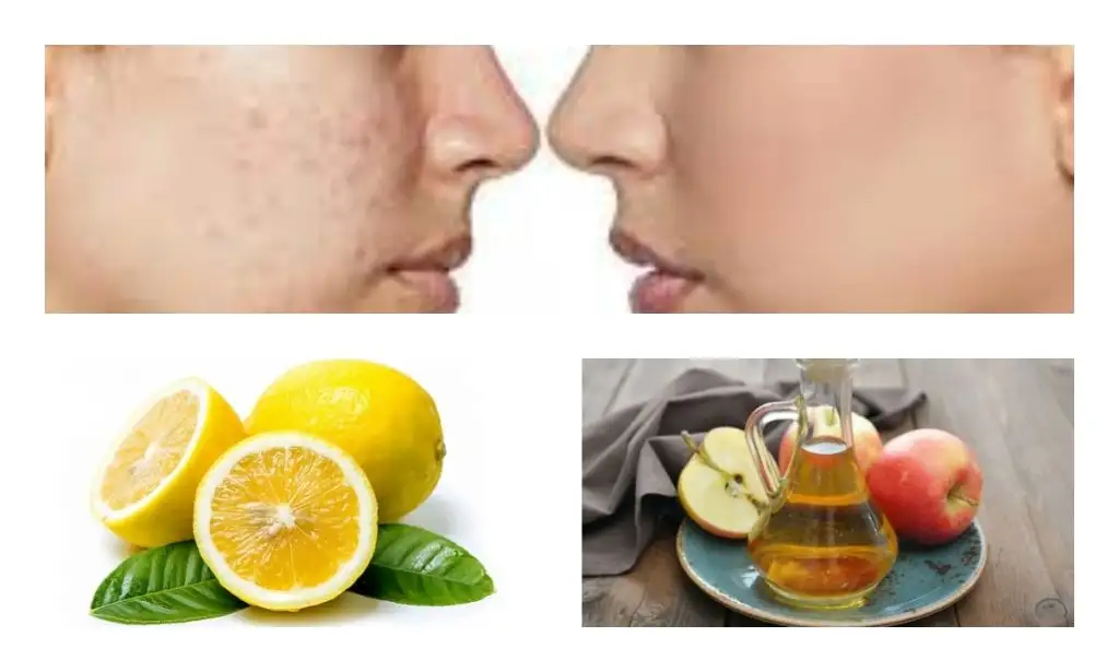 evde_cilt_lekelerine_dogal_cozum.webp