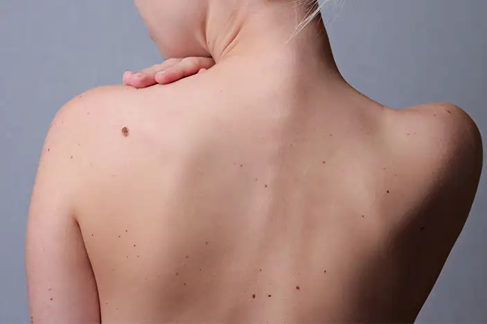 gunes_lekelerine_karpuz_pirinc_maskeleri.webp