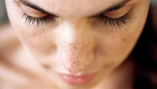 gunes-lekelerine-iyi-gelen-maske-1.webp