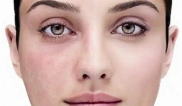 yuzdeki_kirmizi_noktalar_lekeler_nasil_gecer_dogal_yontemleri.webp