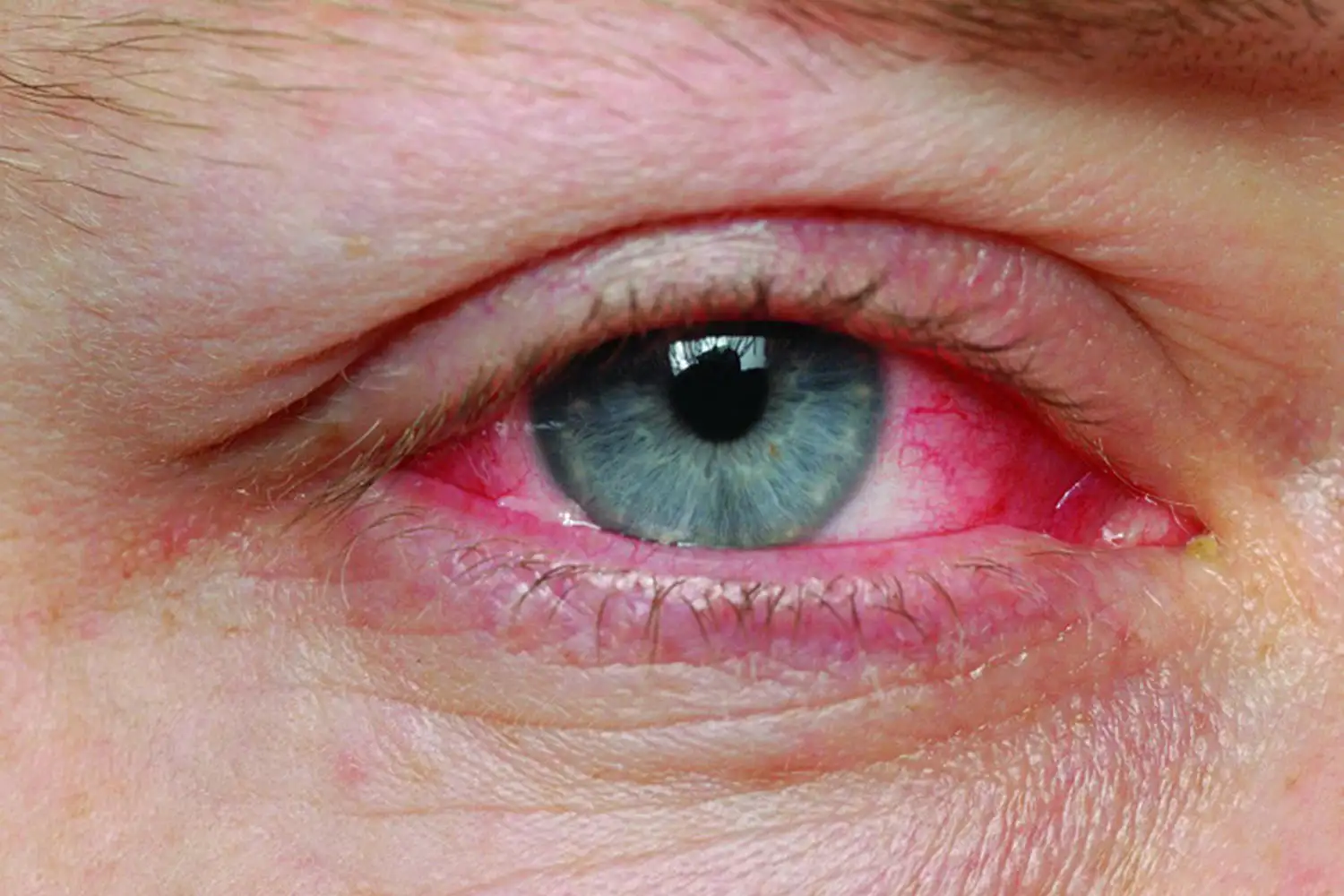 kirmizi_goz_pembe_goz_hastaligi_dogal_tedavisi.webp