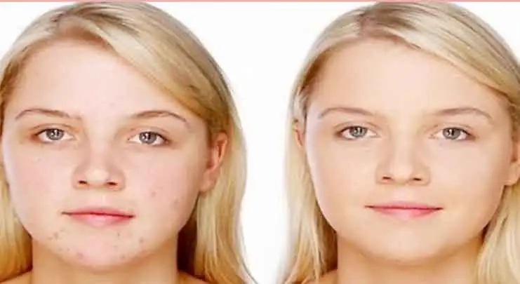 kistik_sivilce_nasil_gecer_maske_tarifleri.webp