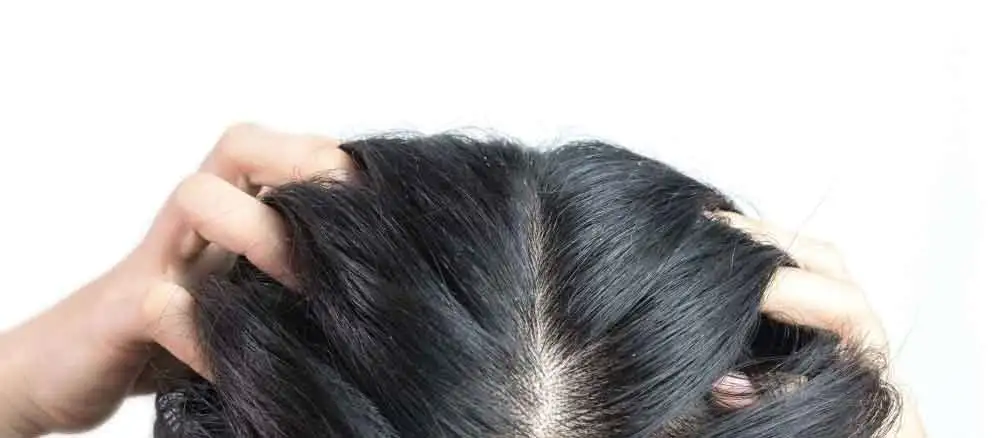Seboreik_Dermatit_Nasil_Gecer_Dogal_Tedavisi.webp