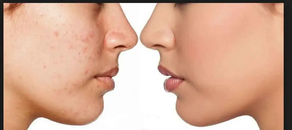 sivilce_cukurlari_maske_tarifi_nasil_gecer.webp