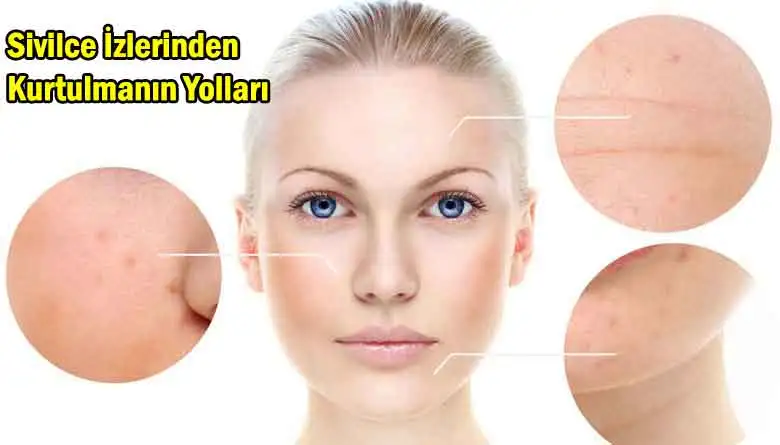 sivilce_izlerinden_kurtulma_yollari_maske_tarifi.webp