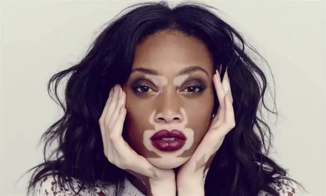 Vitiligo_dogal_maske_tarifi_tedavisi.webp