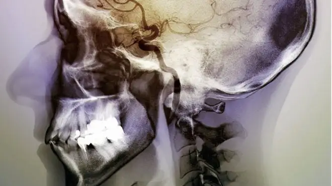 150908101202__85411354_m1360349-stroke_angiogram-spl-1.webp