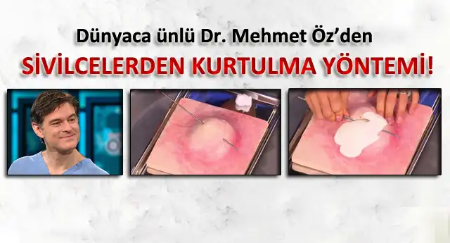 2014-10-30-mehmet-ozden-sivilce-onerisi-igneyle-delin.webp