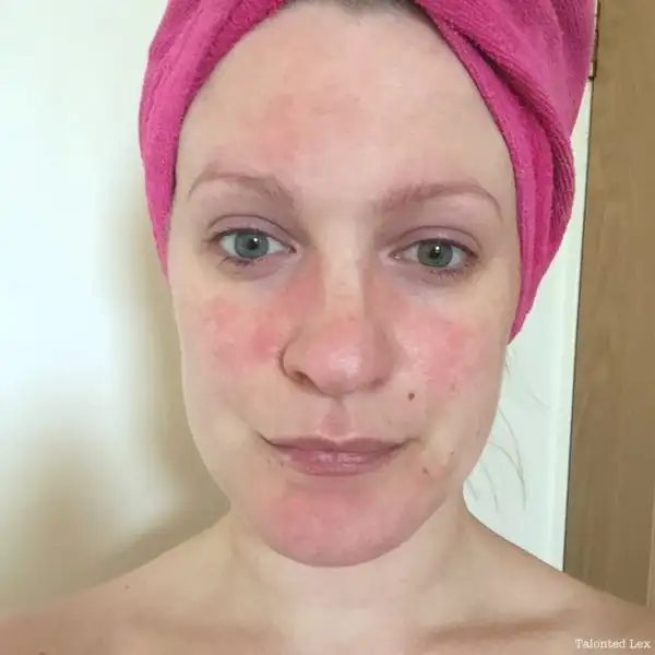 978f1d816a9dd6a699a307add8d198fa--treatment-for-rosacea-ted.webp