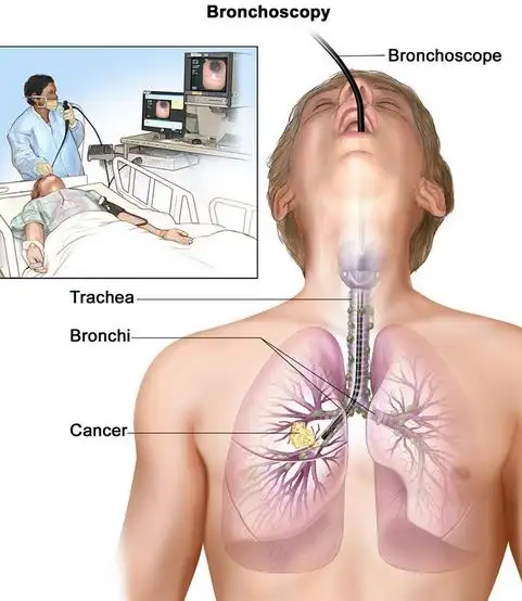 akciger-kanseri-belirtileri.webp
