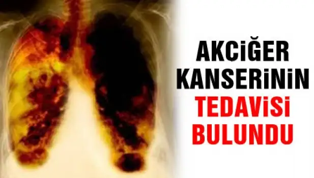 akciger_kanserinde_yeni_cigir_h4066.webp
