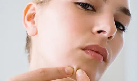 akne_tedavisi_icin_neler_yapmali_1.webp