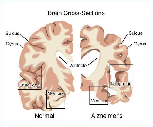 alzhei11.webp