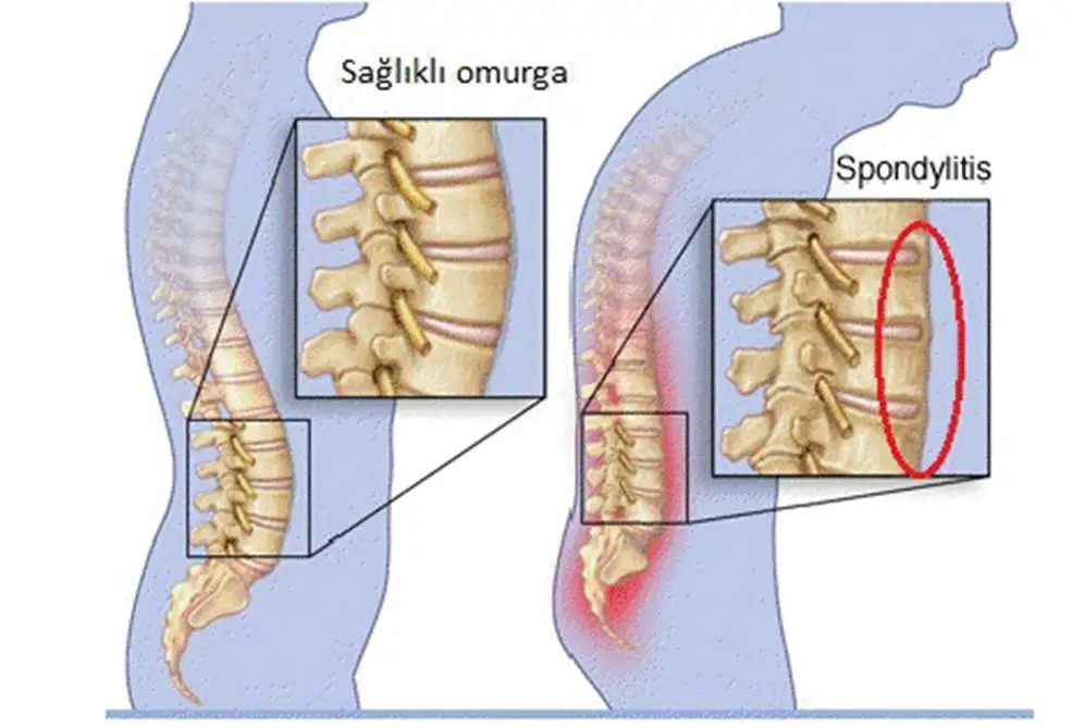 ankilozan spondilit,yaslilik,bel agrilari tedavi dr kamil teker.webp