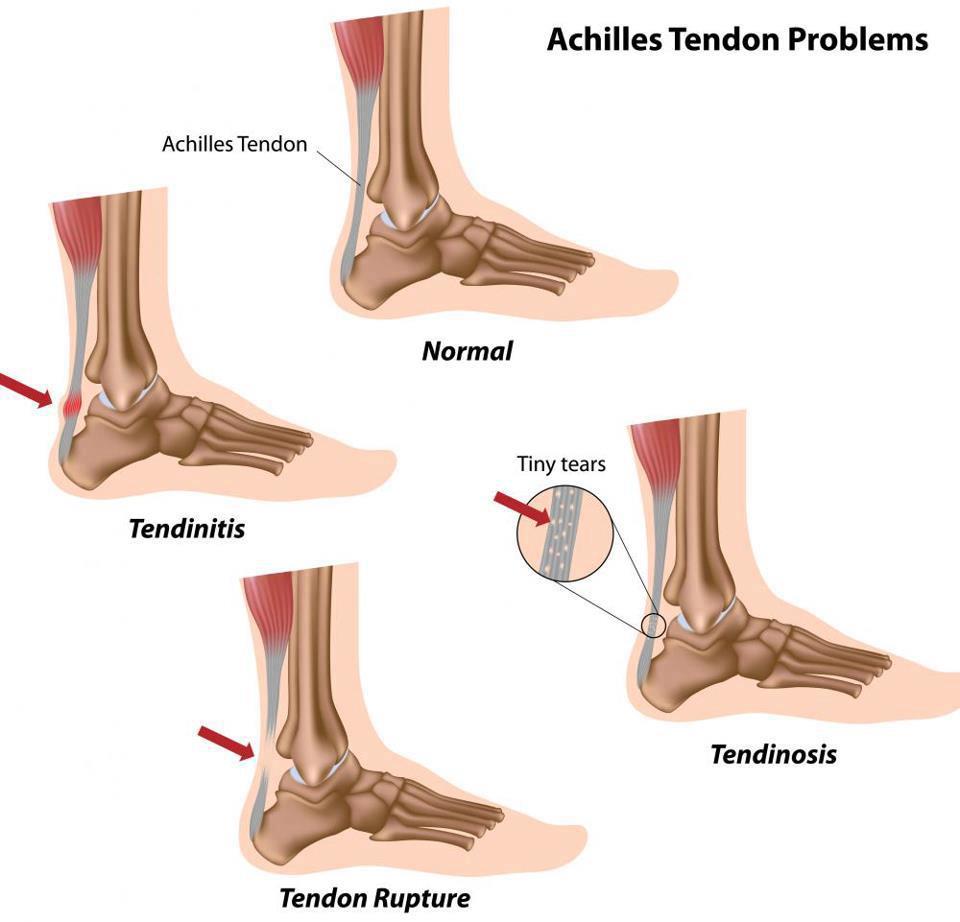 asil-tendonu-kopmasi.jpg