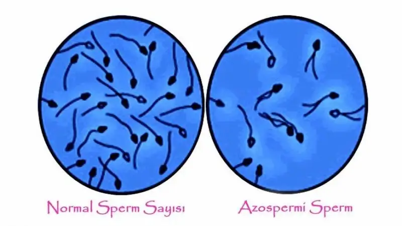 azospermi-konusuna resim.webp