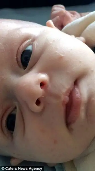 bebegin-yuzundeki-sislikler-korkutuyor-6842626.webp