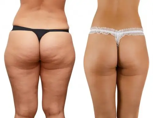 before-and-after-squats-photos.webp