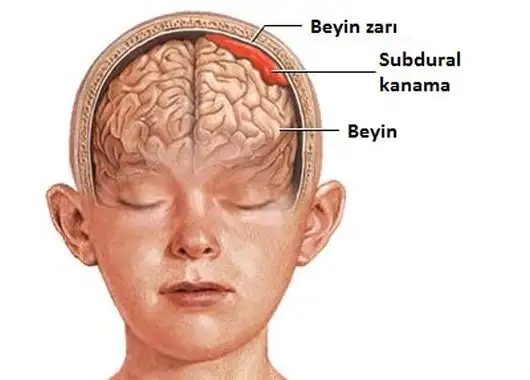beyin-kanaması.webp