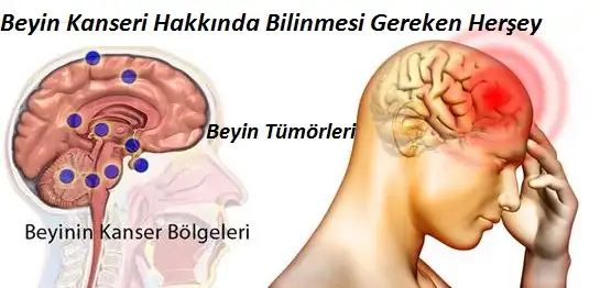 Beyin-Kanseri-Tümörü-Hakkında-Bilinmesi-Gereken-Herşey.webp