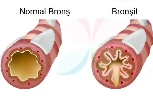 Bronchitis.webp