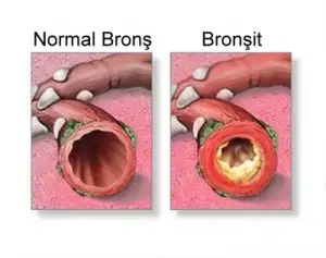 bronsit-300x237.webp