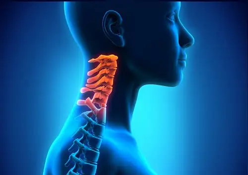 cervicogenic1.webp