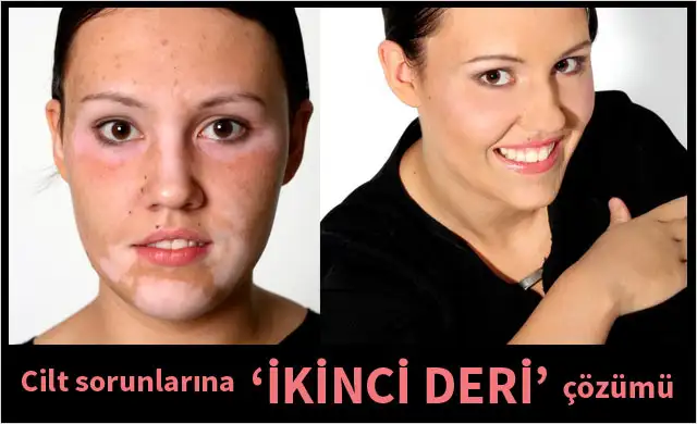 cilt-sorunlarina-ikinci-deri-5476609.webp