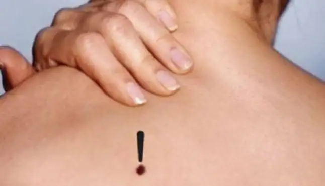 cilt_kanserinin_belirtileri_nelerdir_h30331.webp