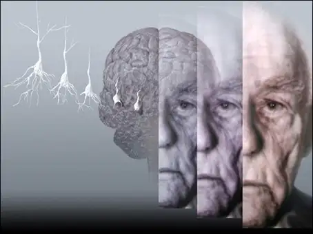 depsicologia.com.wp-content.uploads.alzheimer_thumb.webp