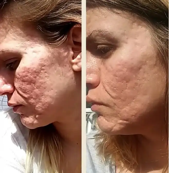 derma_rolu_sivilce_izleri_gecirme.jpg