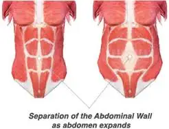 diastasis recti.webp