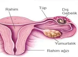 dış-gebelik-1.webp