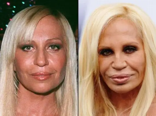 donatella-versace-plastic-surgery.webp