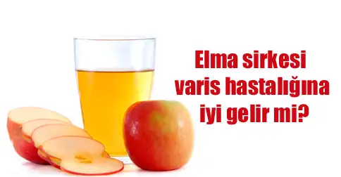 elma-sirkesi-ile-varis-tedavi.webp