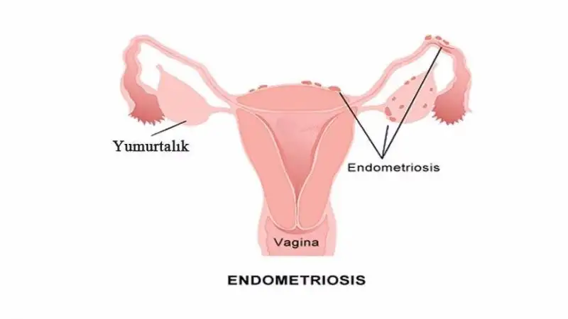 endometriosis1-319x7ak51mnri787naqx34.webp