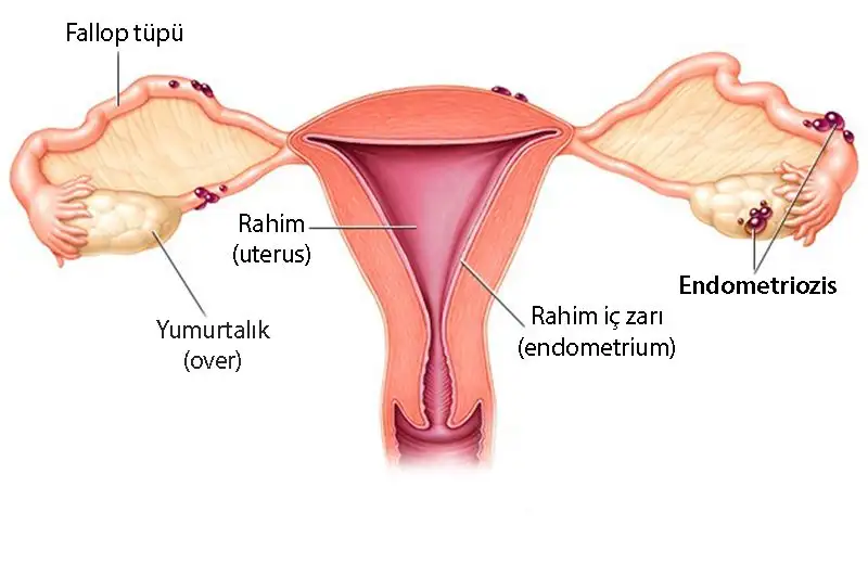endometriozis-nedir-nasil-olusur-rahim-uterus-yumurtalik-over-fallop-tupu-764498.webp