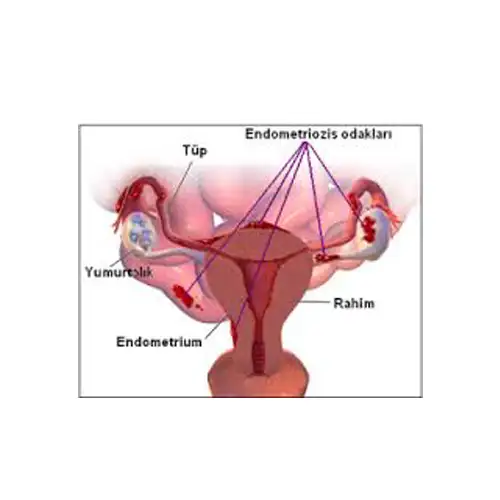 Endometriozis.webp