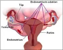 endometriozis.webp