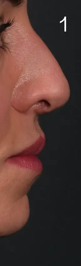 erhan-nose-mid-1now.webp