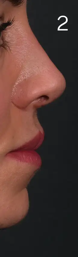 erhan-nose-mid-2erhan.webp
