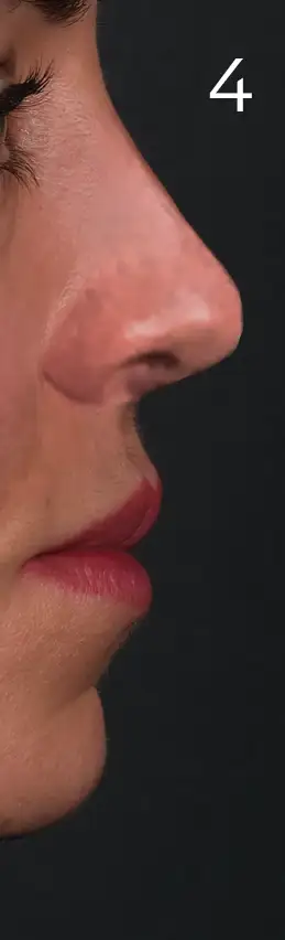 erhan-nose-mid-4tas.webp
